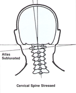 Chiropractic Irvine CA Cervical Spine Stressed Chiropractic Irvine CA Cervical Spine Stressed