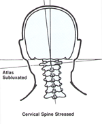 Chiropractic Irvine CA Cervical Spine Stressed